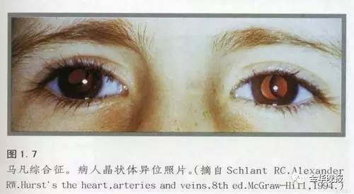 心脏排异是什么意思_换心脏排异_心脏排异怎么办
